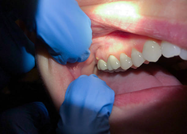 Best Teeth Whitening  in Milton, GA