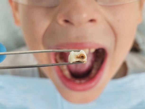 Best Dentist for Tooth Abscess  in Milton, GA